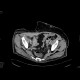 Small hematoma in the right groin, after angiography: CT - Computed tomography